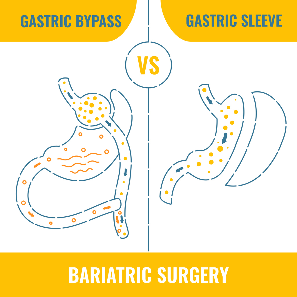 Quelle est la différence entre une sleeve gastrique et un by-pass gastrique?