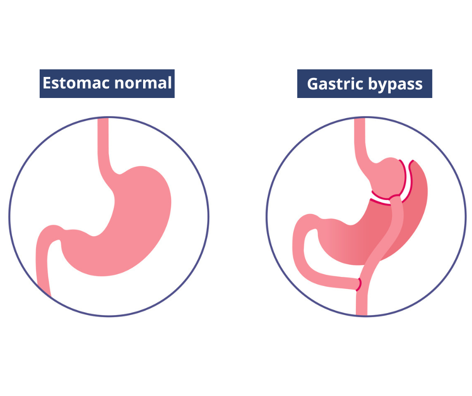 Illustration d’un estomac normal et d’un estomac après un bypass gastrique