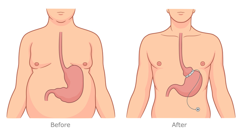 Illustration : avant et après la pose d’un anneau gastrique